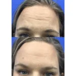 Neuromodulators Before After | ANEU Med Spa in Madison, WI