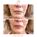 Neuromodulators Before After | ANEU Med Spa in Madison, WI