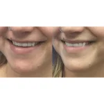 Neuromodulators Before After | ANEU Med Spa in Madison, WI