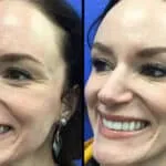 Neuromodulators Before After | ANEU Med Spa in Madison, WI