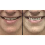Neuromodulators in McFarland, WI | ANEU Medical Spa McFarland, WI