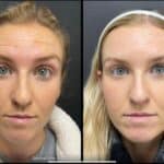 Neuromodulators Before After | ANEU Med Spa in Madison, WI