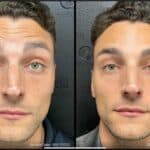 Neuromodulators Before After | ANEU Med Spa in Madison, WI