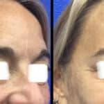 Neuromodulators Before After | ANEU Med Spa in Madison, WI