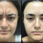 Neuromodulators Before After | ANEU Med Spa in Madison, WI