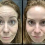 Neuromodulators Before After | ANEU Med Spa in Madison, WI