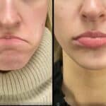 Neuromodulators Before After | ANEU Med Spa in Madison, WI