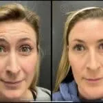 Neuromodulators Before After | ANEU Med Spa in Madison, WI