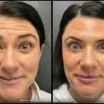 Neuromodulators Before After | ANEU Med Spa in Madison, WI