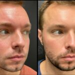 Neuromodulators Before After | ANEU Med Spa in Madison, WI