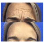 Neuromodulators Before After | ANEU Med Spa in Madison, WI