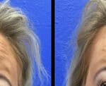 Neuromodulators Before After | ANEU Med Spa in Madison, WI