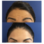 Neuromodulators Before After | ANEU Med Spa in Madison, WI