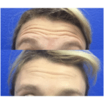 Neuromodulators Before After | ANEU Med Spa in Madison, WI