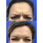 Neuromodulators Before After | ANEU Med Spa in Madison, WI