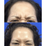 Neuromodulators Before After | ANEU Med Spa in Madison, WI