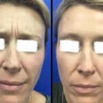 Neuromodulators Before After | ANEU Med Spa in Madison, WI