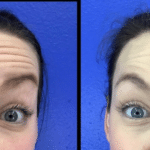 Neuromodulators Before After | ANEU Med Spa in Madison, WI