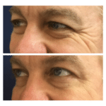 Neuromodulators Before After | ANEU Med Spa in Madison, WI