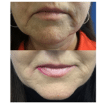 Neuromodulators Before After | ANEU Med Spa in Madison, WI