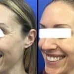 Neuromodulators Before After | ANEU Med Spa in Madison, WI