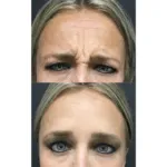 Neuromodulators Before After | ANEU Med Spa in Madison, WI