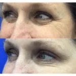 Neuromodulators Before After | ANEU Med Spa in Madison, WI