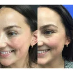 Neuromodulators Before After | ANEU Med Spa in Madison, WI