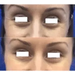 Neuromodulators Before After | ANEU Med Spa in Madison, WI