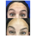 Neuromodulators Before After | ANEU Med Spa in Madison, WI
