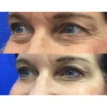 Neuromodulators Before After | ANEU Med Spa in Madison, WI