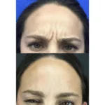 Neuromodulators Before After | ANEU Med Spa in Madison, WI