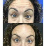 Neuromodulators Before After | ANEU Med Spa in Madison, WI