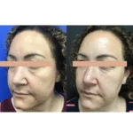 Neuromodulators Before After | ANEU Med Spa in Madison, WI
