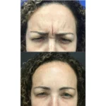 Neuromodulators Before After | ANEU Med Spa in Madison, WI