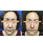 Neuromodulators Before After | ANEU Med Spa in Madison, WI