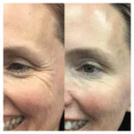 Neuromodulators Before After | ANEU Med Spa in Madison, WI