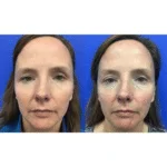 Neuromodulators Before After | ANEU Med Spa in Madison, WI