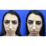 Neuromodulators Before After | ANEU Med Spa in Madison, WI