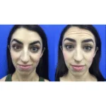 Neuromodulators Before After | ANEU Med Spa in Madison, WI