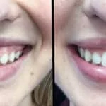 Neuromodulators Before After | ANEU Med Spa in Madison, WI
