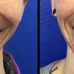 Neuromodulators Before After | ANEU Med Spa in Madison, WI