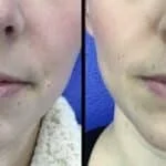 Neuromodulators Before After | ANEU Med Spa in Madison, WI