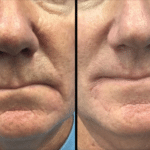 Neuromodulators Before After | ANEU Med Spa in Madison, WI