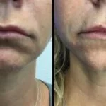 Neuromodulators Before After | ANEU Med Spa in Madison, WI