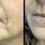 Neuromodulators Before After | ANEU Med Spa in Madison, WI
