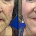 Neuromodulators Before After | ANEU Med Spa in Madison, WI