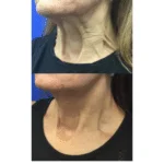 Neuromodulators Before After | ANEU Med Spa in Madison, WI