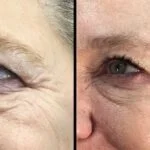 Neuromodulators Before After | ANEU Med Spa in Madison, WI