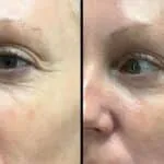 SkinPen Microneedling in McFarland, WI | ANEU Medical Spa McFarland, WI